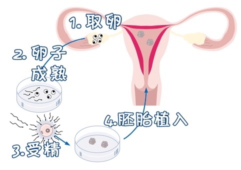 正规拉拉供卵代孕咨询